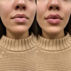 cosmetic injectables results
