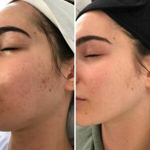 platelet rich plasma facial