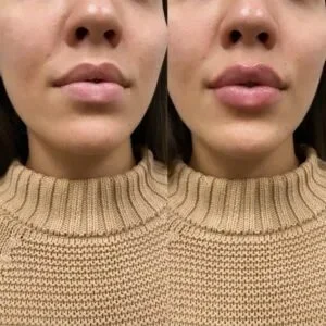 أفضل خدمات حقن التجميل في جدة