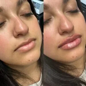 تكلفة حقن التجميل في جدة