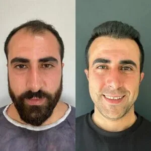 تكلفة زراعة الشعر في جدة