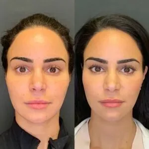 حقن التجميل في السعودية