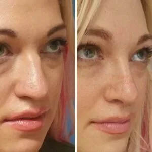 جراحة تجميل الأنف التجميلية