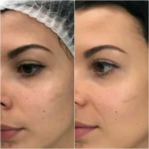 علاج معزز البشرة